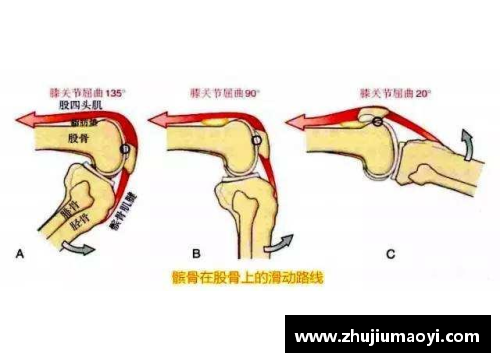 J9旗舰厅髌骨软化症：运动员的隐忧与康复之道